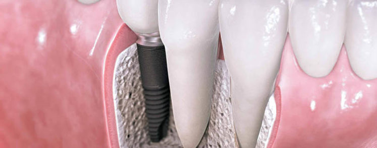 Implantes dentales en Sabadell
