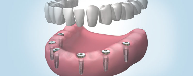 Implantes dentales en Sabadell de última generación