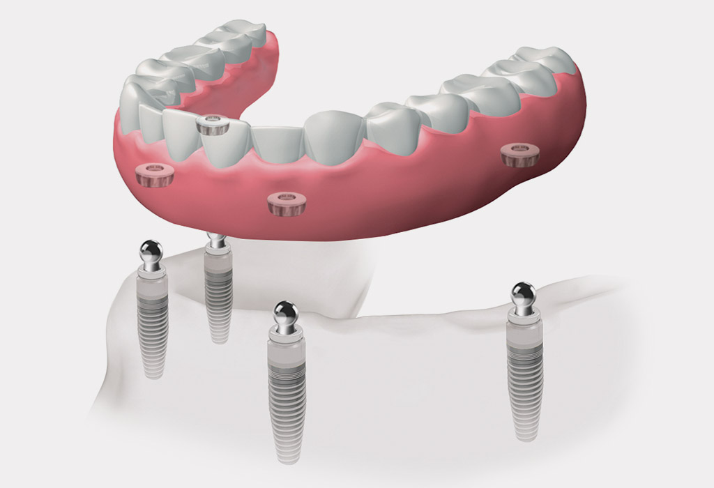 implantes dentales en Sabadell