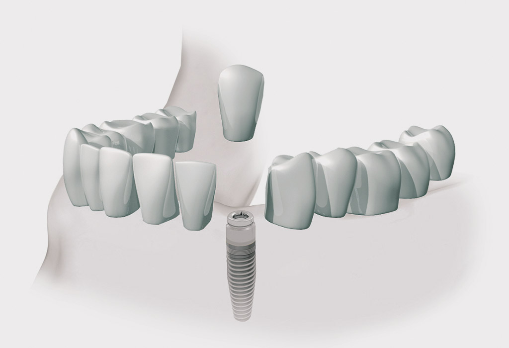 implantes dentales en Sabadell