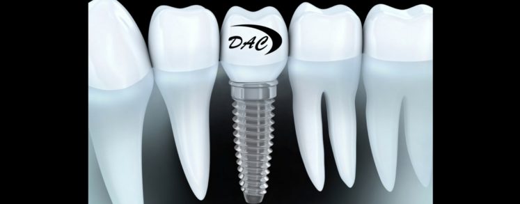 Los implantes dentales inmediatos y postextracción