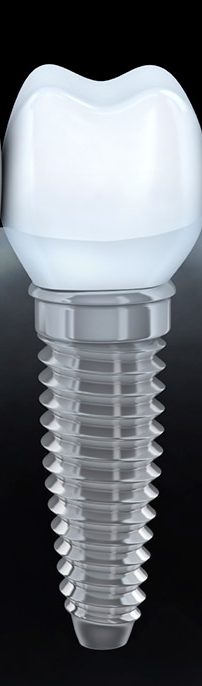 Implantología dental en Sabadell
