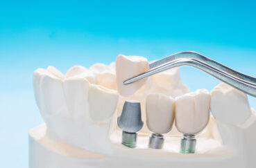 Cuidados de los implantes dentales en Sabadell