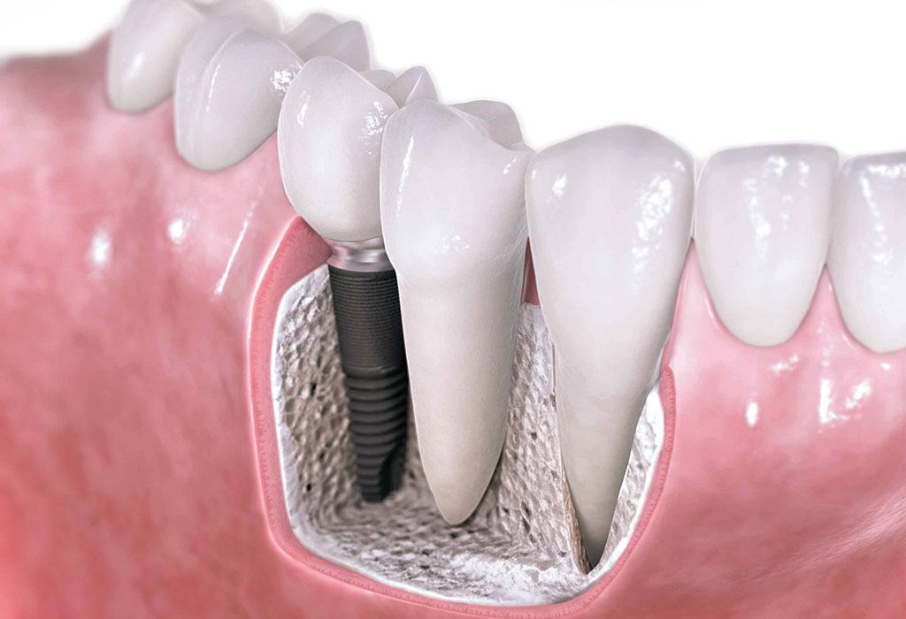 Implantes dentales con cirugía mínimamente invasiva en Sabadell