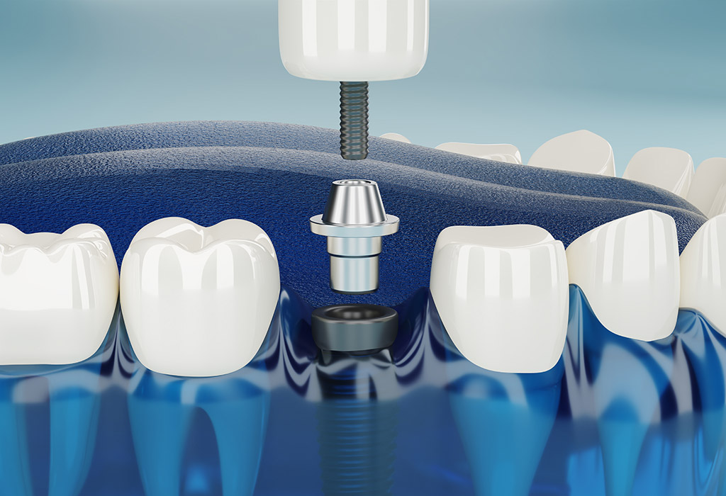 implante dental en Sabadell