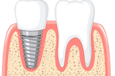 Partes de los implantes dentales