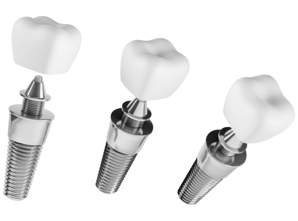 implantes dentales sabadell