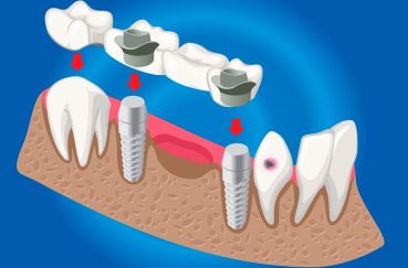 implantes dentales postextracción o cirugía mínima