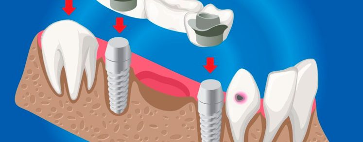 Los implantes dentales postextracción o cirugía mínima