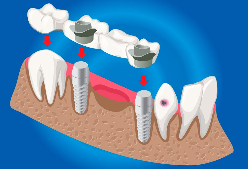 implantes dentales postextracción o cirugía mínima