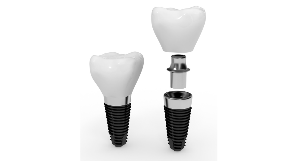 Dentatesthetic Corporation, especialistas en implantes dentales en Sabadell