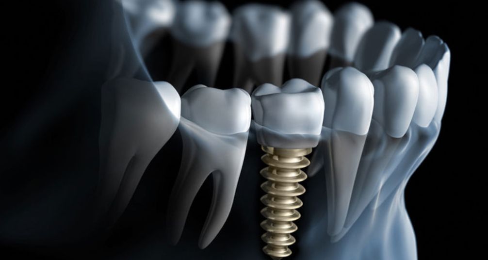 Implantes dentales en Sabadell con implantología mínimamente invasiva
