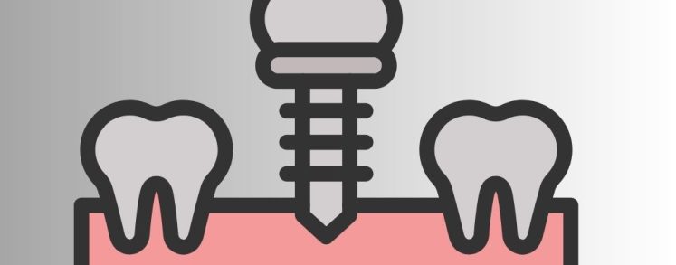 Por qué elegir DAC para tus implantes dentales: precio económico y alta calidad con garantía europea