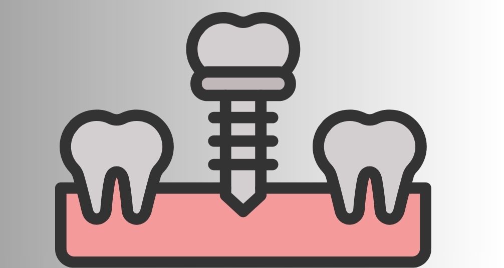 implantes dentales: precio